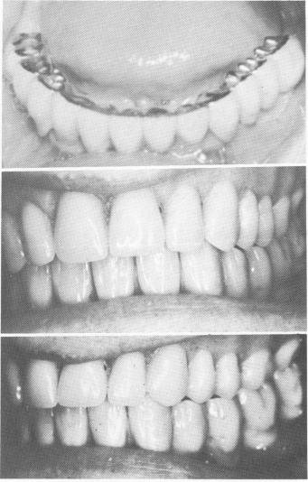 3 Mandibular bridges cemented into positions with oxyphosphate of zinc