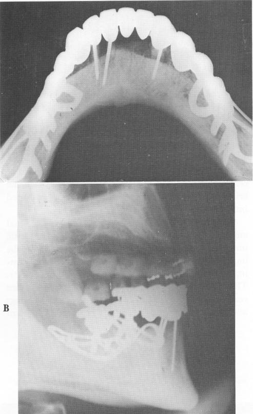 1 X ray of mandibular subperiosteal implant & endodontic root stabilizer