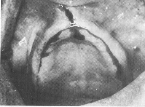 2 Incision along crest of ridge from one maxillary tuberosity to other