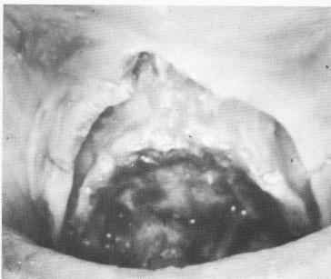 3 Fibromucosal tissue on maxilla retracted to expose underlying parts
