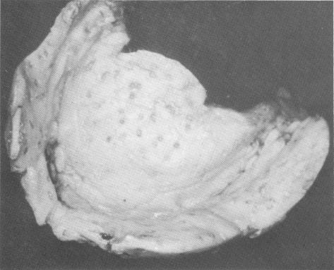 2 Maxillary acrylic tray trimmed & notched in inner & outer surfaces 