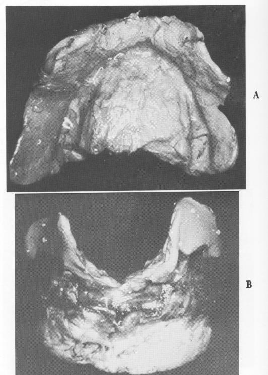 3 Rubber base impression of maxillary exposed bone site