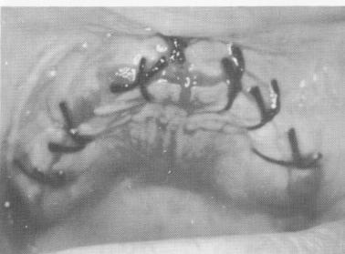1 Maxillary tissues sutured together after subperiosteal implant seated