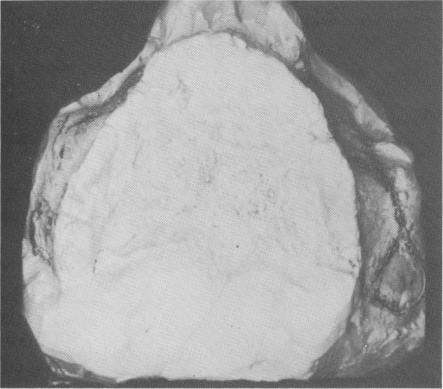 2 Maxillary tissues sutured together after exposing bone