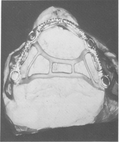 3 Knife like ridge of the maxilla seen on master stone model