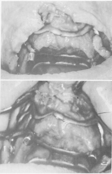 4 Maxillary implant fits accurately over the duplicate bone mode