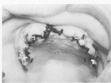 1 Mattress or purse string suturing around each maxillary post done