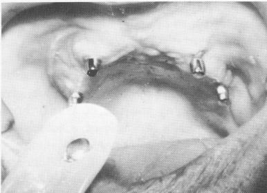 2 Old denture hollowed out & relined with Hydro Cast for temporary use