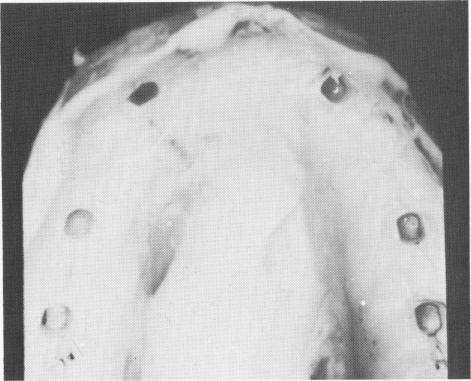 3 Upper palateless implant denture ready for insertion after healing 