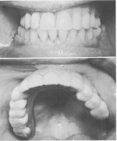 4 Palateless denture is implant borne & not touches fibromucosal tissue