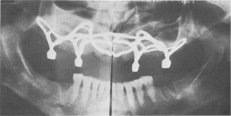 1 Maxillary subperiosteal implant shows topography of bone that it covers