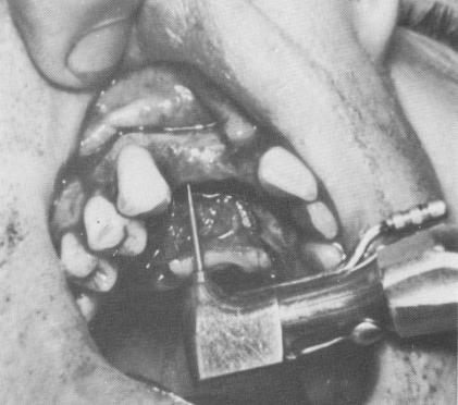 2 Preoperative picture showing missing right central & lateral incisors