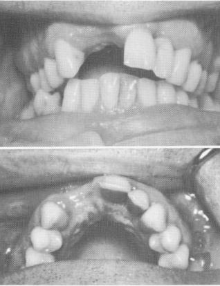 3 Tissue incised in maxillary arch to expose the underlying bone