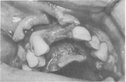 4 Transfixation pins drilled in alveolar bone, palatal to labial surface