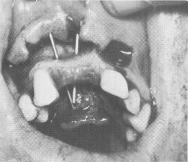 1 Pins transfixed through maxillary bone prior to elastic impression