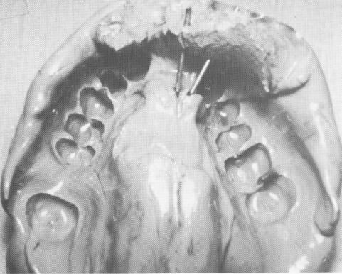 2 Pins removed from impression in mouth & later kept back outside mouth