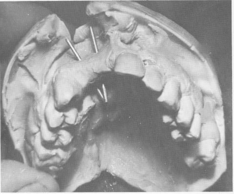 3 Upper master stone model poured into impression with pins fixed inside