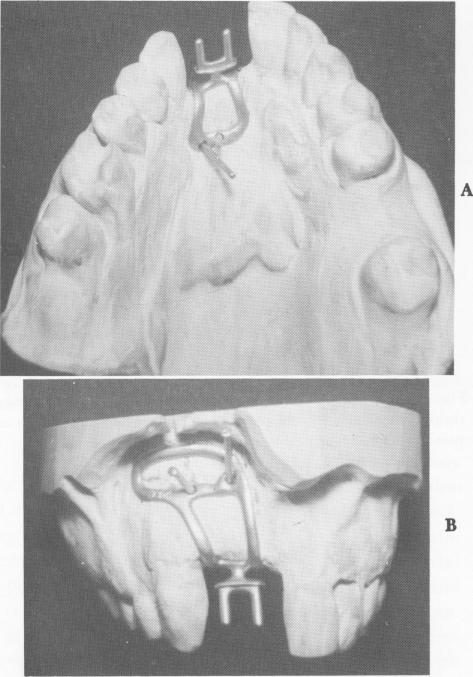 4 Unilateral subperiosteal implant with specially cast cobalt chrome pin