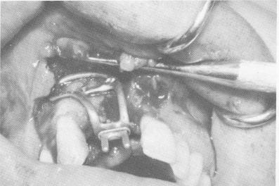 1 Implant locked to jaw bone by lingual extensions of transfixation pin 