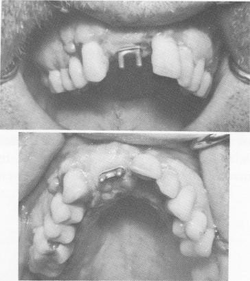 2 Tissues sutured to cover maxillary implant & adapt to protruding posts