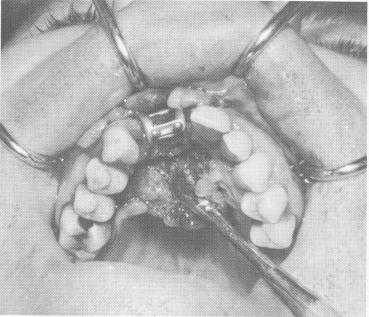 3 Two unit acrylic splint cemented over protruding posts in maxilla