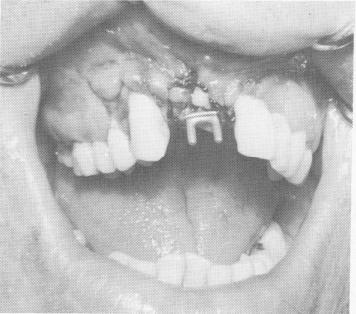 4 X ray showing subperiosteal implant with horizontal transfixation pins