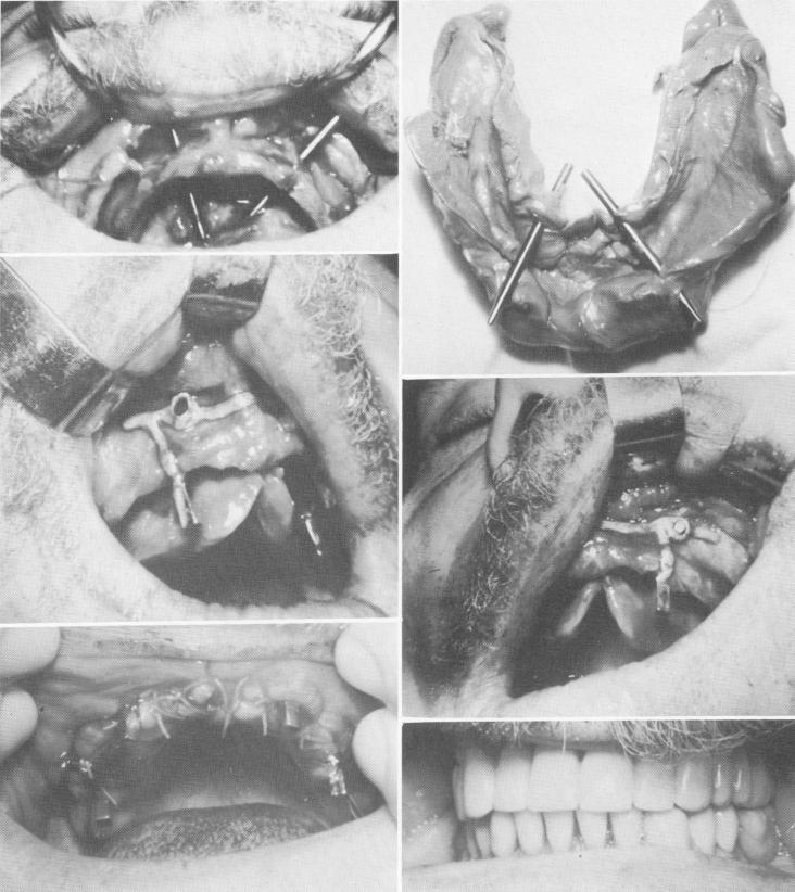 1 Picture showing two maxillary transfixation pins of larger diameter 