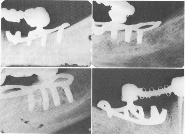 1 Intraoral x rays of unilateral subperiosteal implants as abutments