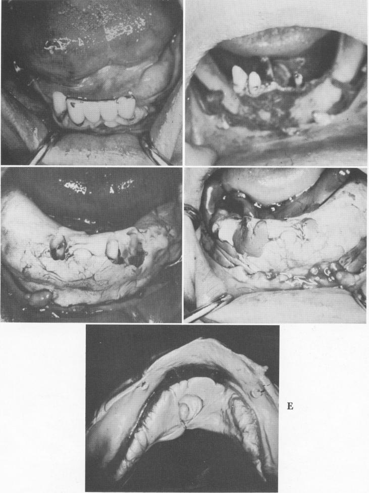 1 Only three teeth supported the lower anterior splint