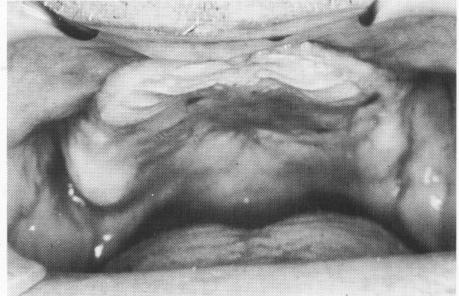 1 Flattened maxillary ridge