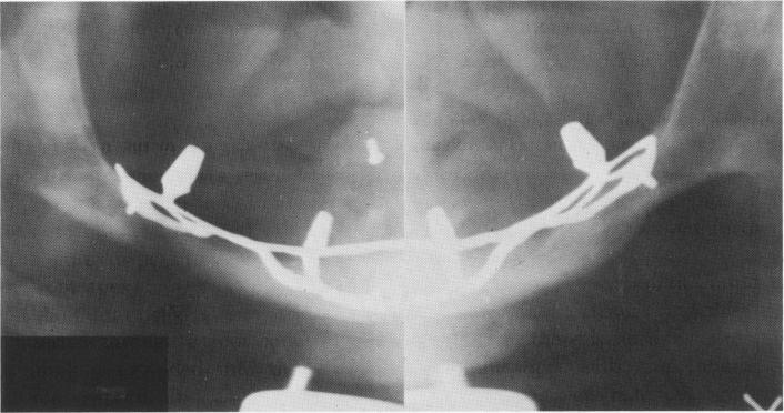 2 Subperiosteal implant fabricated for mandible & no bone below sinus