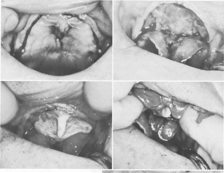 1 Rubber base impression of hard palate taken inside acrylic tray