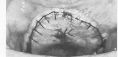2 Subperiosteal toroplant with parallel posts & holes for fixative screws