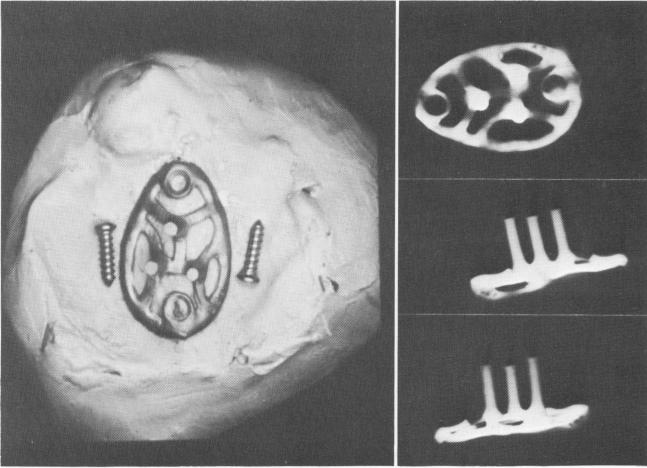 3 Casting for maxillary arch commercially radiographed for porosities