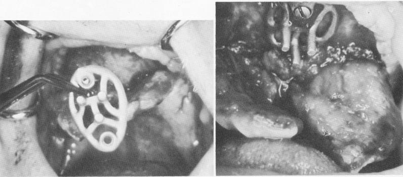 1 Three protruding posts punched through maxillary palatal tissue