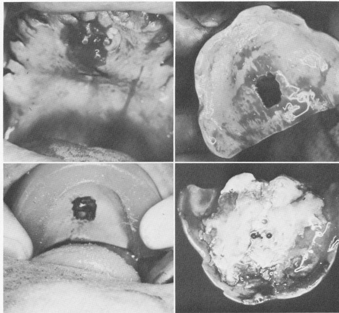 2 Hole cut out through palatal portion of bite registration block 
