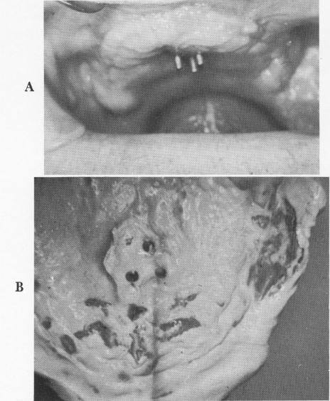 1 Inside of bite registration block relined with silicone 