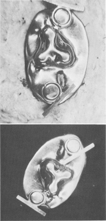 2 Special maxillary template with ring lock resilient type attachments