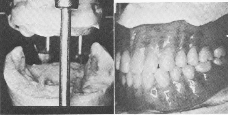 4 Implant dentures mounted on the articulator