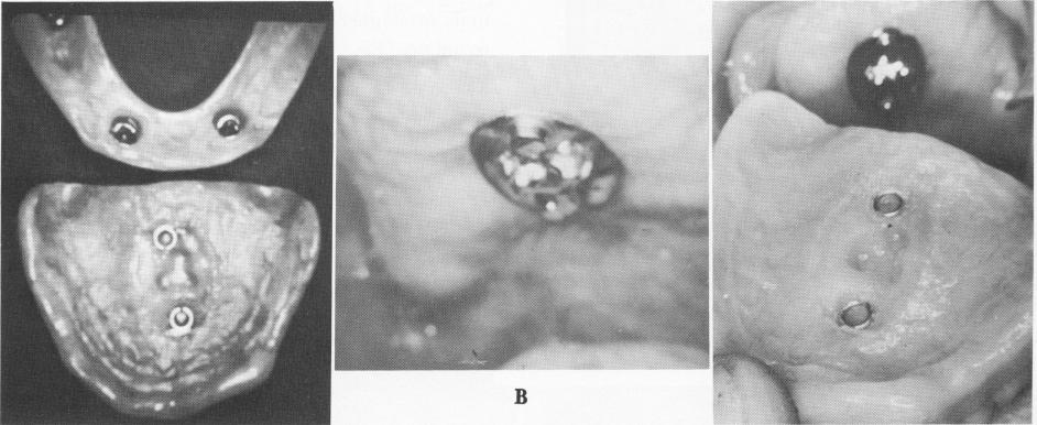 1 Undersurface of both upper and lower dentures