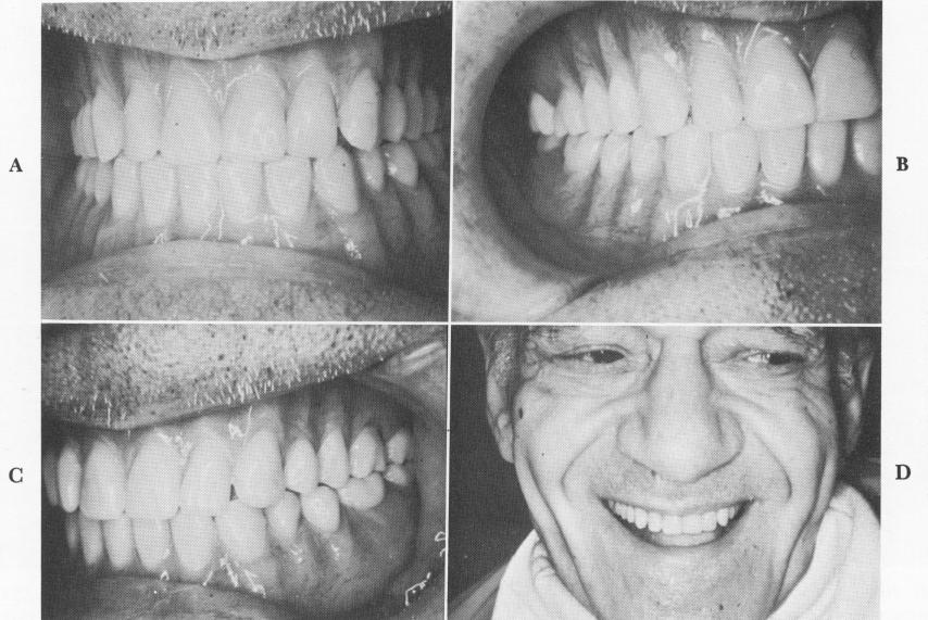 2 Template cemented over the implant posts in maxilla