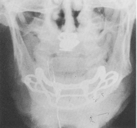 1 X ray of maxillary toroplant & mandibular subperiosteal implant