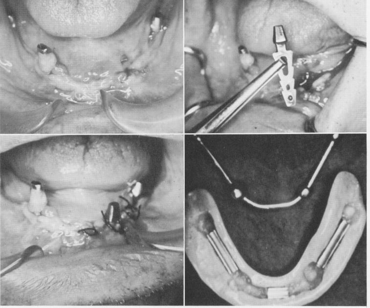 2 Left anterior mandibular post broken off from substructure framework