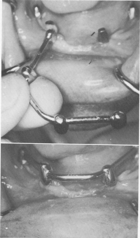 1 Mandibular mesostructure cemented over four implant posts