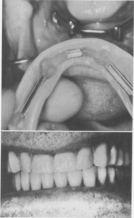 2 Mandibular implant denture with its internal clip bar attachments 