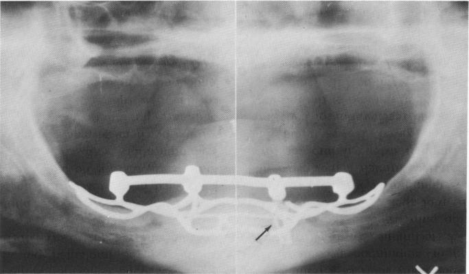 1 Endosseous blade implant splinted to subperiosteal implant posts