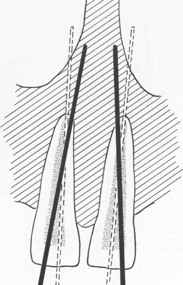 1 Endodontic pins angled to lodge in the nasal spine & septum