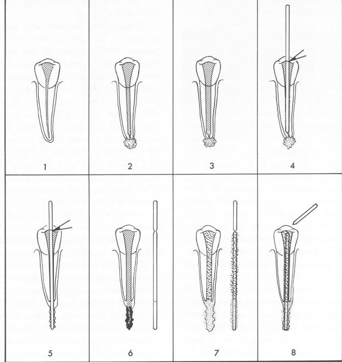 1 Orlay`s eight stage endodontic pin insertion procedure