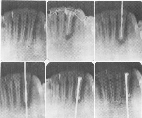 1 Simplified Edelman & Linkow endodontic implantation technique