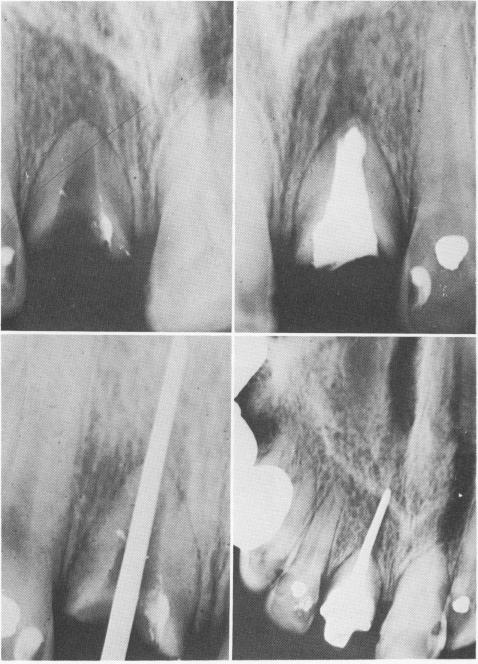 2 Lengthening a short tooth root to accept restoration